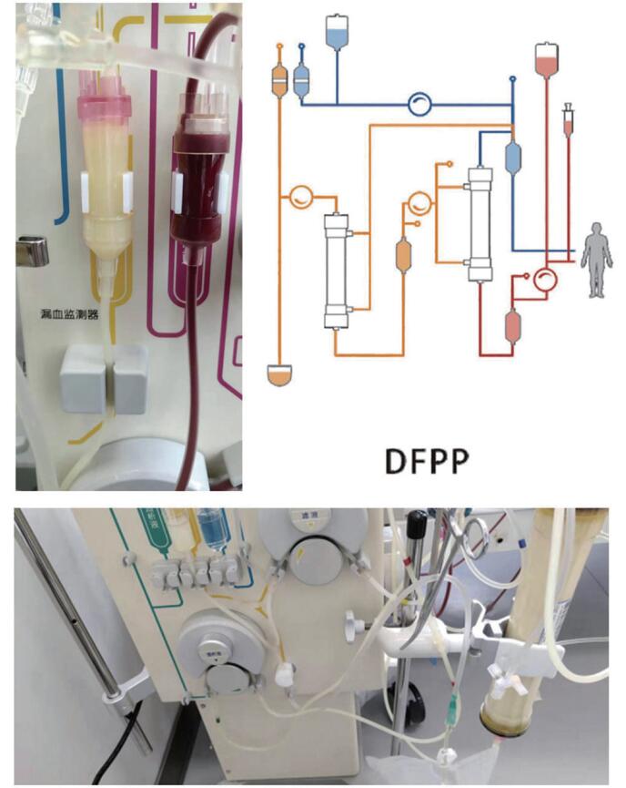 DFPP治療和流程圖.jpg