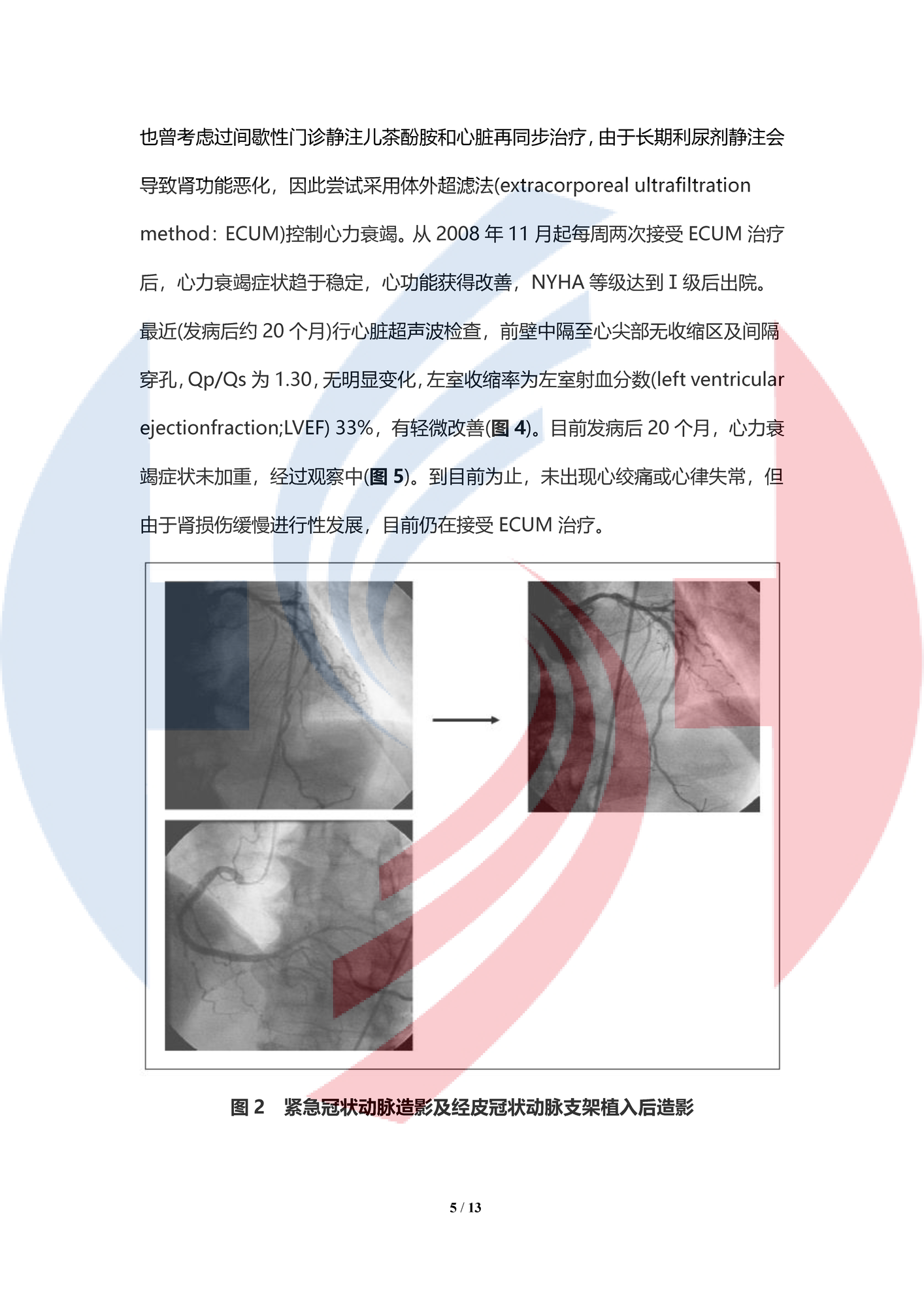 【中譯水印】體外超濾治療急性前壁間壁心肌梗塞后嚴重心力衰竭合并長期存活中的室間隔穿孔1例_頁面_05.png