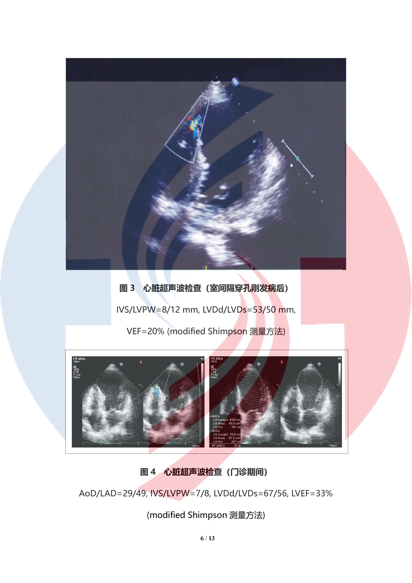 【中譯水印】體外超濾治療急性前壁間壁心肌梗塞后嚴重心力衰竭合并長期存活中的室間隔穿孔1例_頁面_06.png